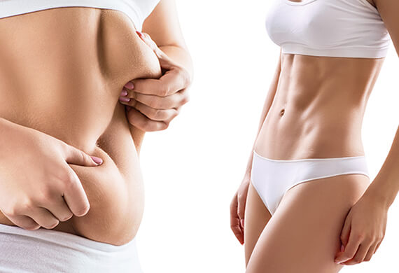 Tummy Tuck Surgery in Gurgaon | abdominal fat removal