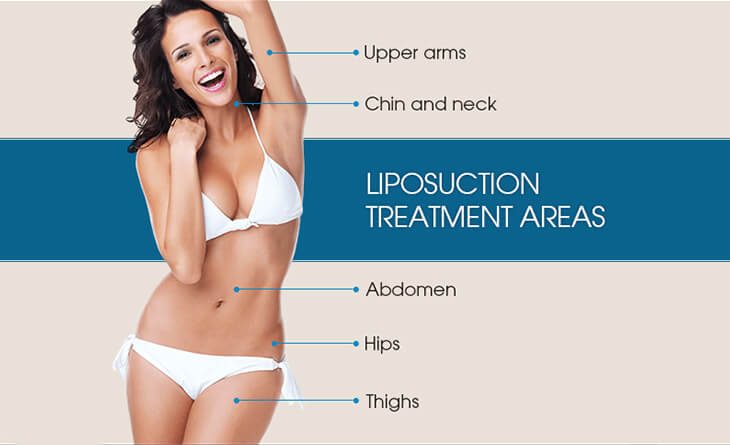 liposuction surgery in gurgaon