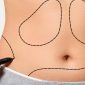 Body Contouring surgery in gurgaon