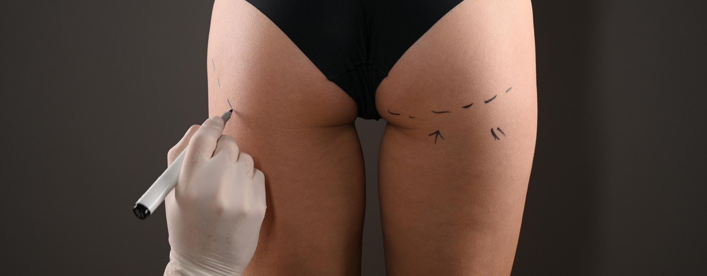 Brazilian Butt Lift Surgery